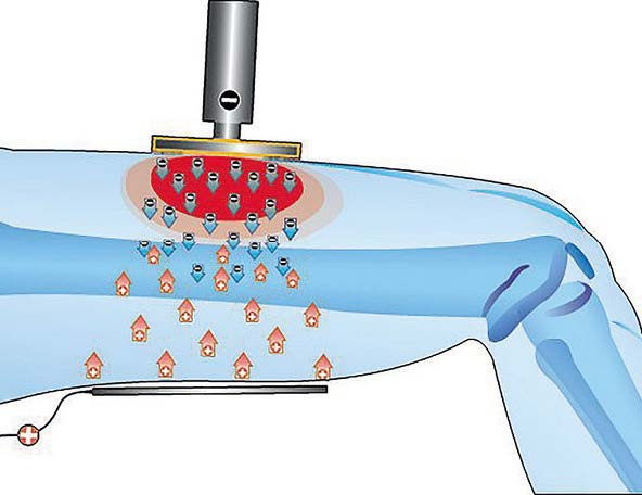 Imagen de Mexicano crea un dispositivo de fisioterapia